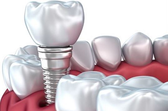 آنچه باید در مورد ایمپلنت های دندانی بدانیم