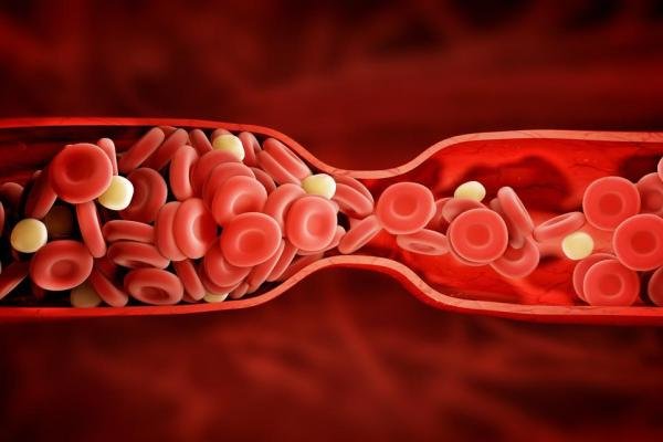 ارتباط قرص های ضدبارداری با افزایش لختگی خون در زنان چاق