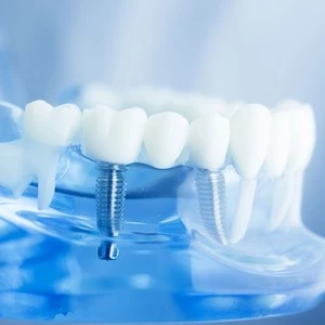 نکاتی مهمی که باید درباره ایمپلنت دندان بدانید