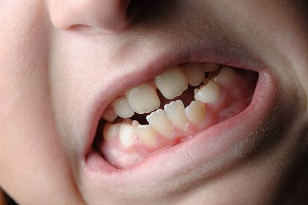 درمان کجی دندان بدون ارتودنسی در خانه!