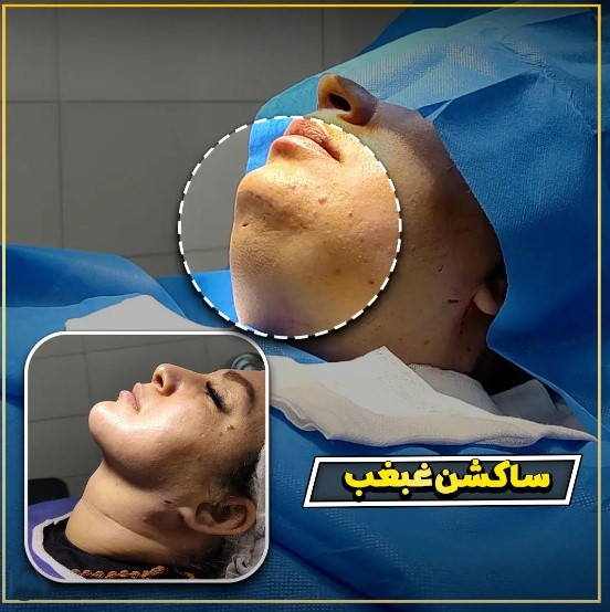 بهترین راه‌های درمان غبغب صورت بدون جراحی