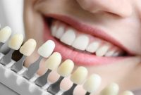 هزینه کامپوزیت دندان و پارامترهای موثر در آن