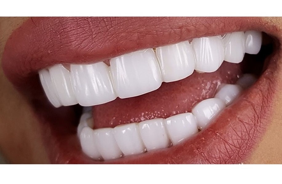 هزینه کامپوزیت دندان و پارامترهای موثر در آن