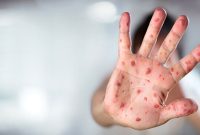 زنگ خطر «سرخک» در شمال کشور