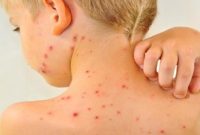 افزایش موارد ابتلا به سرخک در جهان با کاهش میزان واکسیناسیون