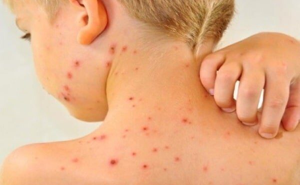 افزایش موارد ابتلا به سرخک در جهان با کاهش میزان واکسیناسیون